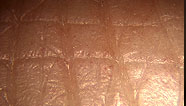 Skin surface squares